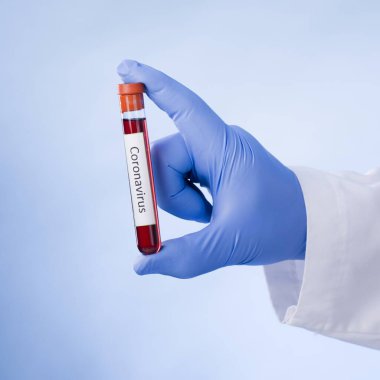 Yeni hızla yayılan Coronavirus, Coronavirus 2019-nCoV kan örneği için pozitif kan testi sonucu. Corona virüsü salgını. Salgın Virüsü Solunum Sendromu.