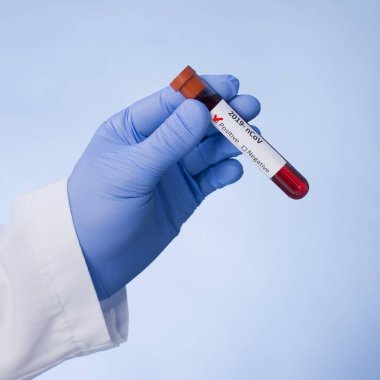Coronavirus 2019-ncov kan örneği. Corona virüsü salgını. Salgın Virüsü Solunum Sendromu.
