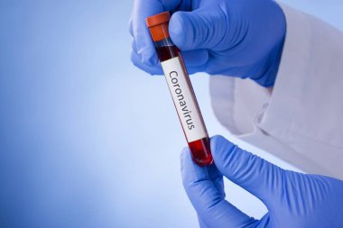 Coronavirus kan testi sonucu vakum test tüpündeki koronavirüs enfeksiyonu laboratuardaki Coronavirus metniyle doktorların ellerinde..