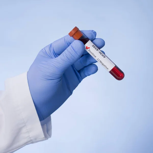 Koronavirus 2019 Ncov Blood Sample Koronový Virus Vypukl Syndrom Respiračního — Stock fotografie