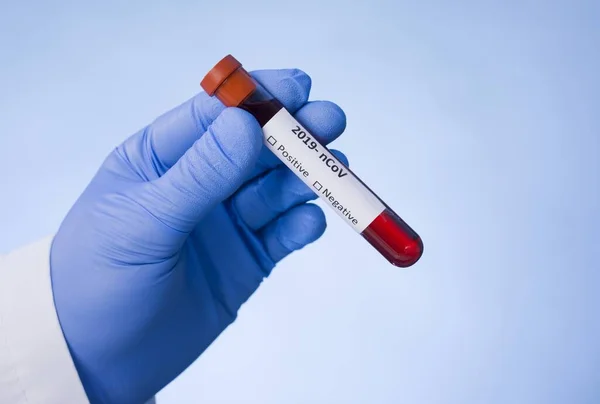Coronavirus Vérvizsgálat Eredménye Vér Fertőzött Koronavírus Vákuum Kémcsőben Orvosok Kezében — Stock Fotó