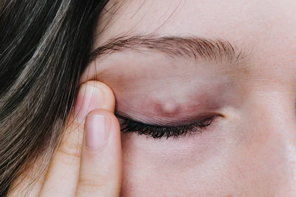 genç kız bir chalazion göz kapağı closeup gösterir.