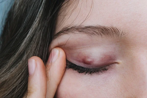 Ung flicka visar en chalazion på ögonlocket närbild — Stockfoto