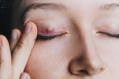genç kız bir chalazion göz kapağı closeup gösterir.