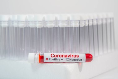 Vakum venipunktur tüpünde Coronavirus enfeksiyonu kan testi örneği