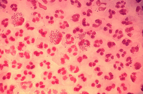 淋球菌性尿道炎的扫描电子显微图像 — 图库照片