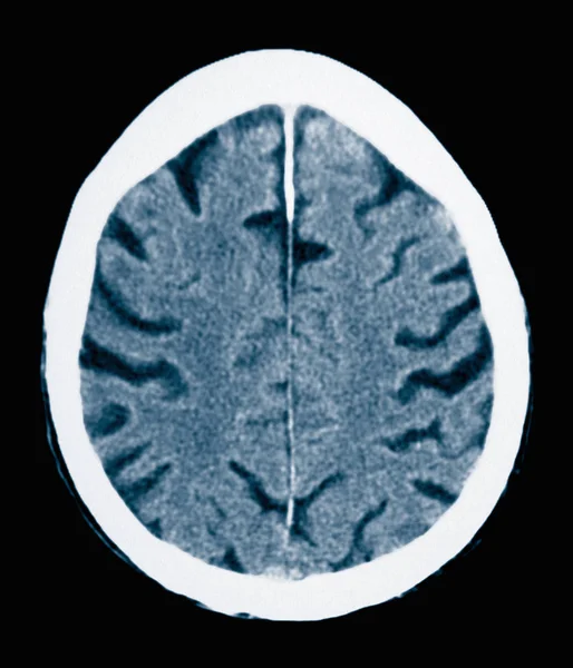 Closeup Shot Scan Old Male Alzheimers Disease — Stock Photo, Image