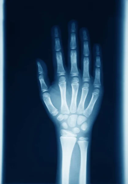 Radiografia originale della mano umana — Foto Stock