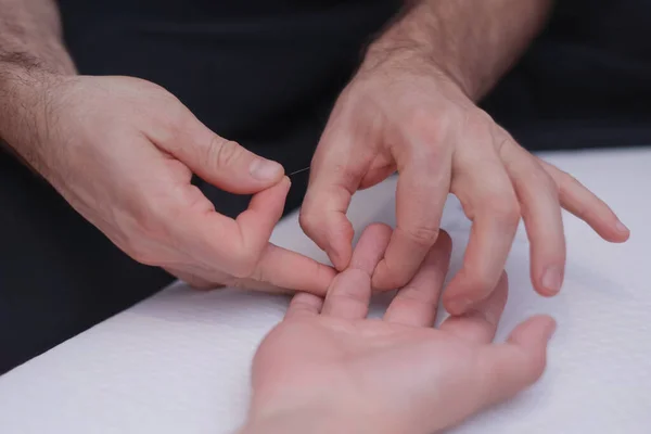 Acupuncture, est utilisé pour soulager la douleur ou à des fins médicinales. Les avantages de l'acupuncture. Soins du corps, stimulation d'une aiguille d'acupuncture sur la main d'un patient . — Photo