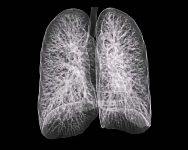 Healthy lungs of a 30 year old patient — Stock Photo, Image