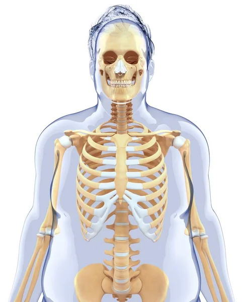 Skeletal system of obese individual — Stock Photo, Image