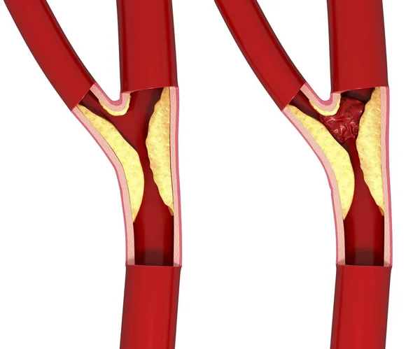 Atherosclerosis and narrowed artery — Stock Photo, Image