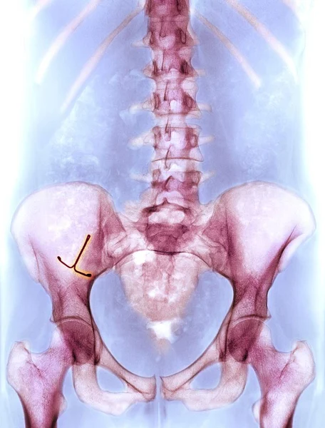 异位宫内节育器避孕 — 图库照片