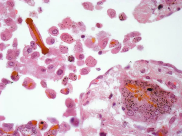 Włókien Azbestowych Tkance Płucnej Lekkie Mikrogram — Zdjęcie stockowe