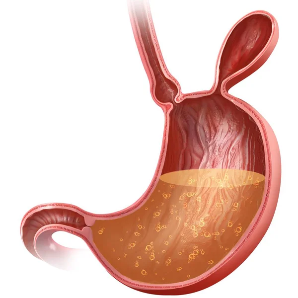Human stomach with hernia — Stock Photo, Image