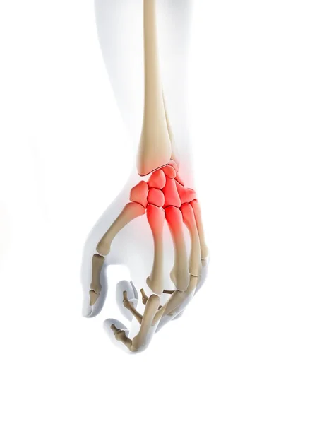 Schematic representation of wrist pain — Stock Photo, Image