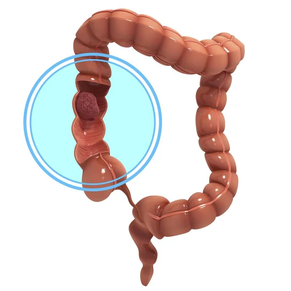 Visszaadás a vastagbél rák — Stock Fotó