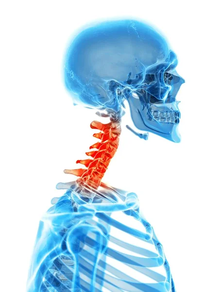 Menselijke cervicale wervelkolom pijn — Stockfoto