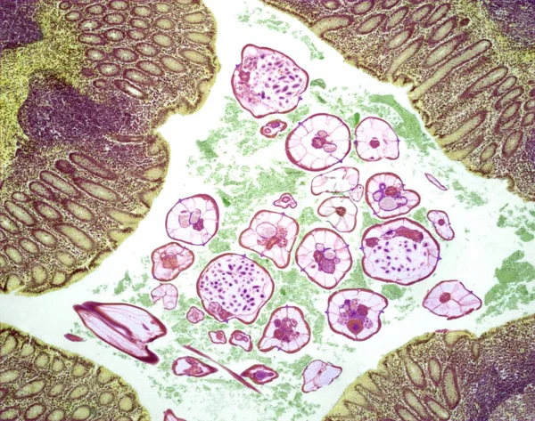 線虫の寄生虫に感染している胃 — ストック写真