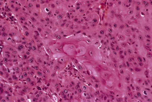 Рак шкіри епідермоїдної карциноми — стокове фото