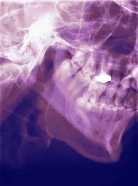 Coloured Profile Ray Human Mandible Lower Jaw — Stock Photo, Image