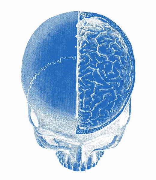 Вырезание верхней части черепа человека — стоковое фото