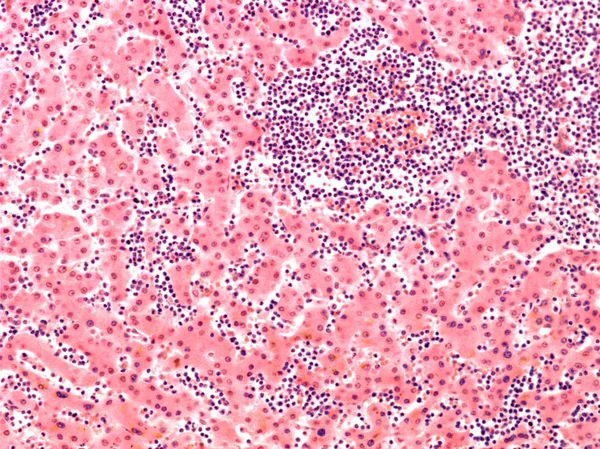 Световая Микрография Клеток Крови Основном Клеток Темно Фиолетовых Печени Пациента — стоковое фото