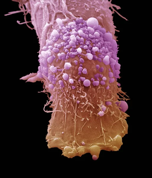 Cilt kanseri hücre — Stok fotoğraf