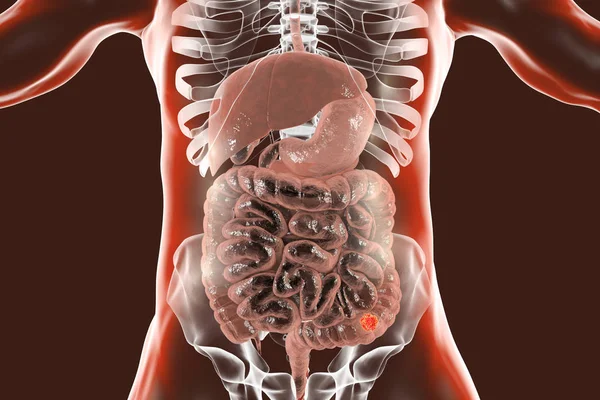人体结肠癌 数字插画 — 图库照片