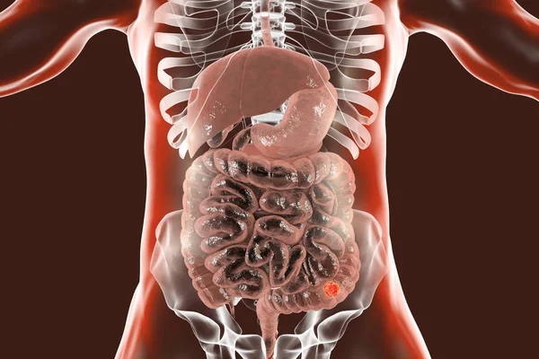 Cáncer Colon Cuerpo Humano Ilustración Digital — Foto de Stock