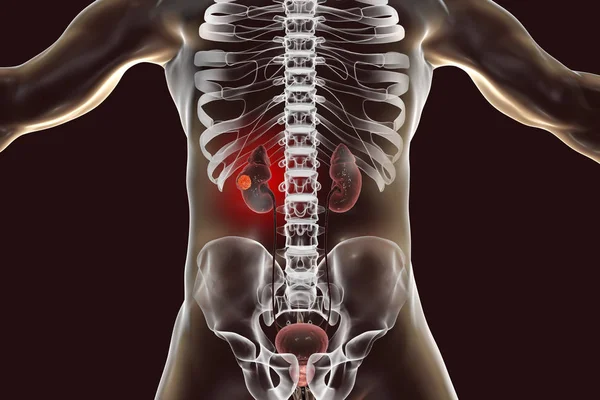 Ilustração Digital Corpo Humano Com Câncer Rins — Fotografia de Stock