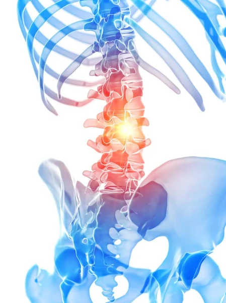 有腰痛的人体骨骼 概念计算机图解 — 图库照片