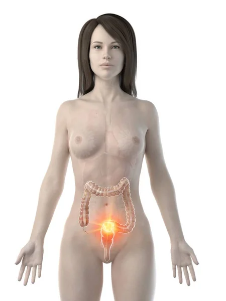 患结肠癌的女性身体 概念计算机图解 — 图库照片