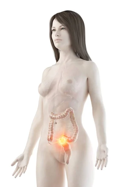 Corpo Femminile Con Cancro Colon Illustrazione Digitale Concettuale — Foto Stock