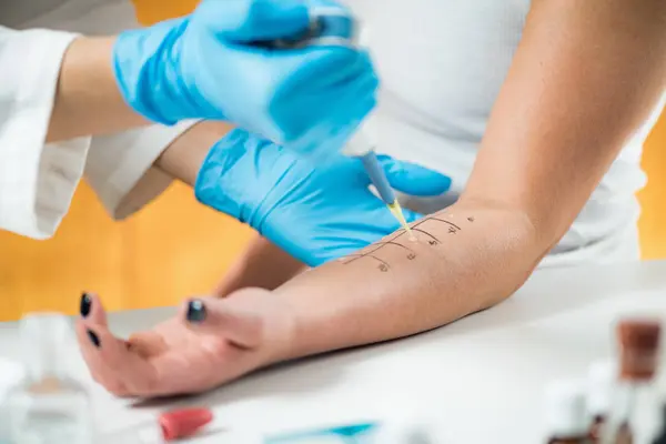 Невпізнаваний Лікар Який Проводить Тест Алергію Шкіру Піпеткою Руці Пацієнта — стокове фото
