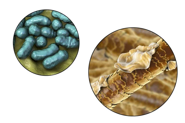 Computer Illustration Showing Human Hair Dandruff Close View Microscopic Fungi — Stock Photo, Image