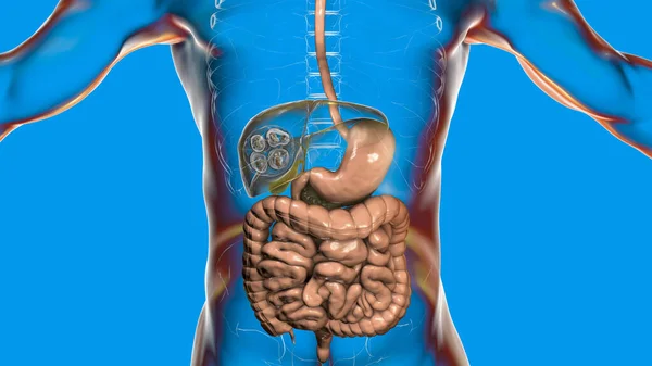 Lebererkrankung Durch Larven Des Parasitären Bandwurms Echinococcus Multilocularis Computerillustration — Stockfoto