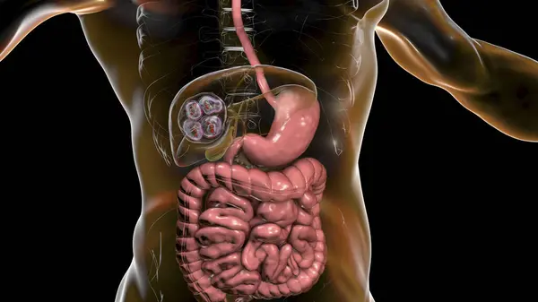 Hydatid Disease Liver Caused Larvae Parasitic Tapeworm Echinococcus Multilocularis Computer — Stock Photo, Image