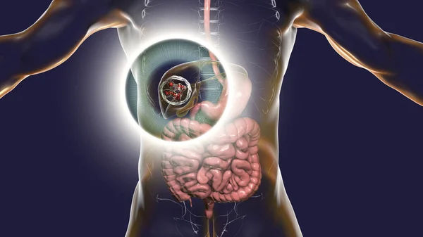 肝臓での肝疾患 嚢胞性エキノコッカス症 コンピュータイラスト — ストック写真