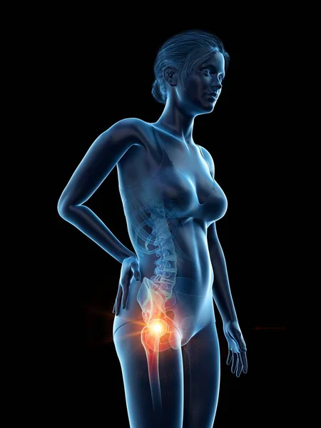 痛みを伴う腰を持つ女性 コンピュータイラスト — ストック写真