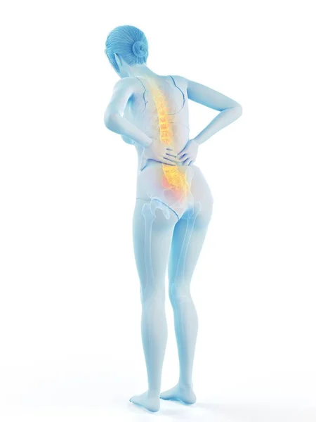 Mujer Con Espalda Dolorosa Ilustración Por Ordenador —  Fotos de Stock