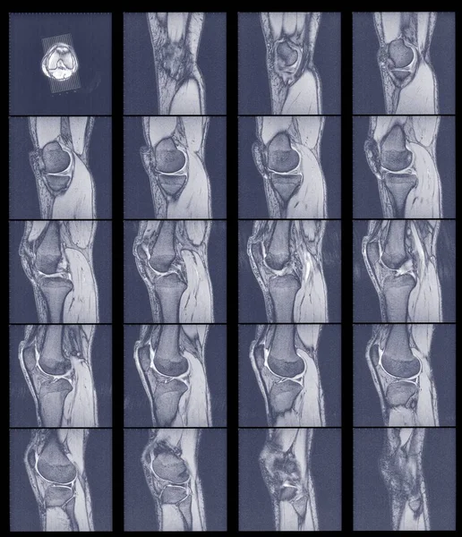Multiple Scans Knee Joint Mri — Stock Photo, Image