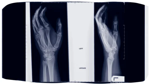 Film Två Händer Röntgen — Stockfoto