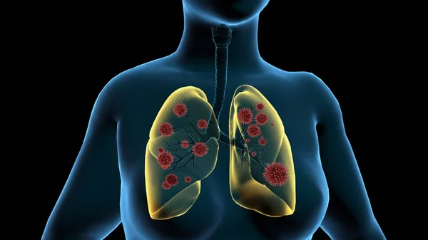 Ilustracja Komputerowa Pokazująca Płuca Kobiety Zakażonej Cząsteczkami Wirusa — Zdjęcie stockowe