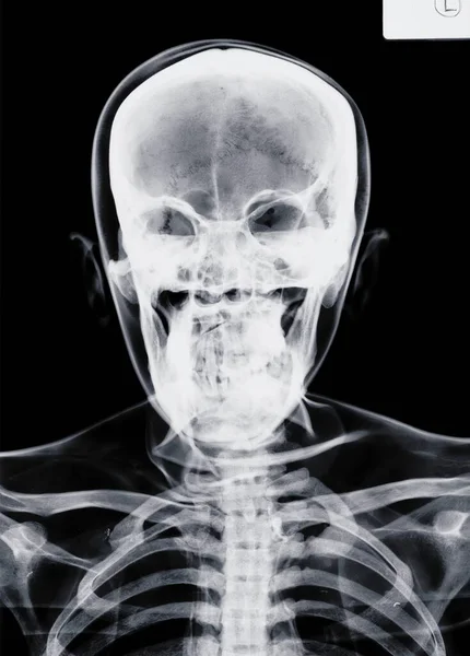 Crânio Humano Raio — Fotografia de Stock