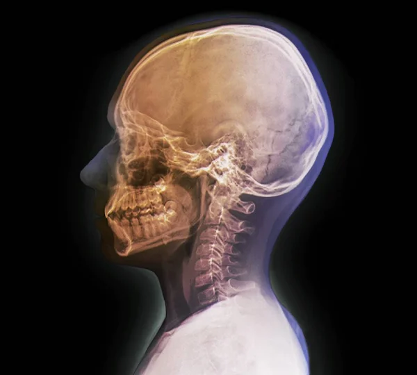 Обычная детская голова. Рентген головы 13-летнего . — стоковое фото