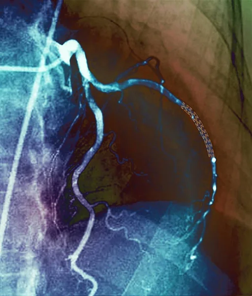 Цветная ангиограмма (рентген кровеносных сосудов) коронарных артерий 52-летнего пациента. В правой артерии установлен стент для лечения закупорки. . — стоковое фото