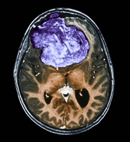 Цветная компьютерная томография (КТ) мозга 25-летнего пациента с менингиомой (синий цвет) ). — стоковое фото
