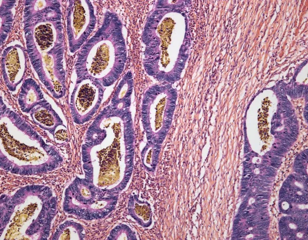 Adenocarcinoma del colon sigmoideo — Foto stock