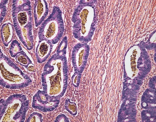 Аденокарцинома сигмоидной толстой кишки — стоковое фото